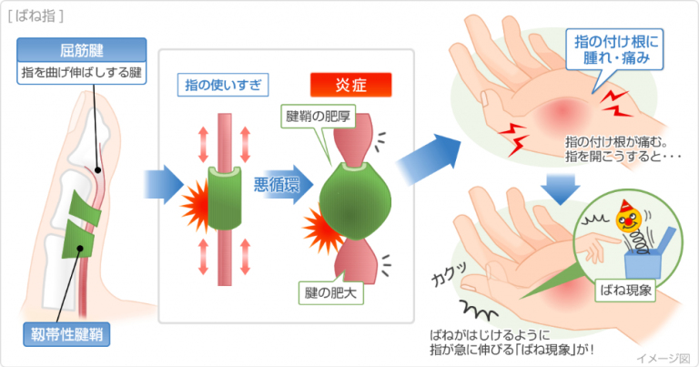 ばね指について | 西新井の整体なら女性の痛みを解決する西新井しみず整骨院